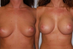 BREAST-AUGMENTATION-CASE-2