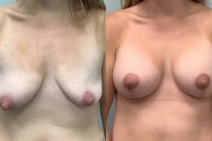 BREAST-AUGMENTATION-CASE-41