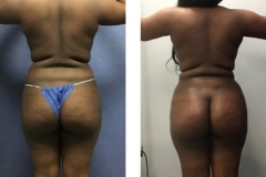 LIPOSUCTION – CASE 2