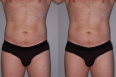 LIPOSUCTION – CASE 11