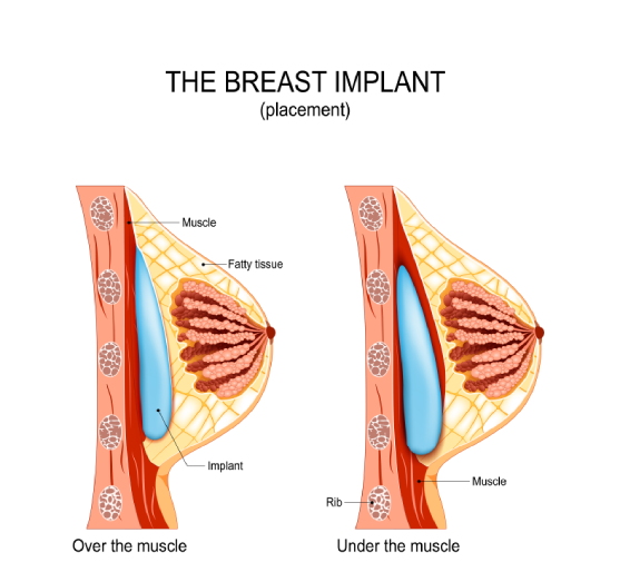 The Breast Implant