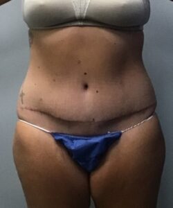 AR 8 Week Post Surgery Front View