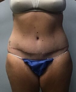 AR 8 Week Post Surgery Front View