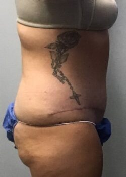 AR 8 Week Post Surgery Side View Right