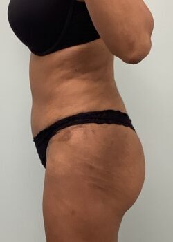 After-Side-1-250x350