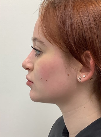 Rhinoplasty Surgery NY & NJ