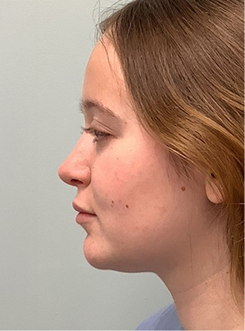 Nose surgery NJ